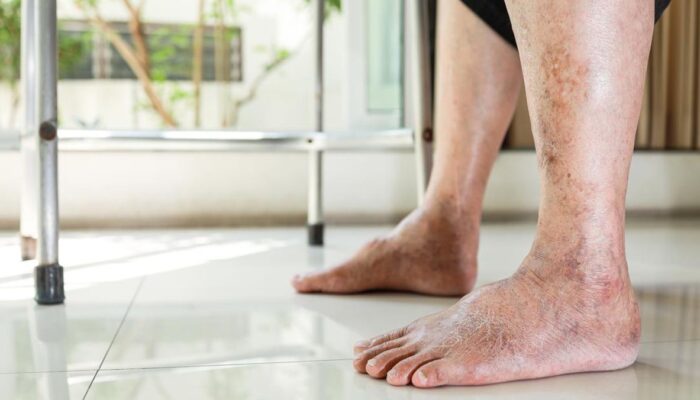 Waspadai Tujuh Gejala Diabetes yang Sering Muncul Saat Bangun Pagi