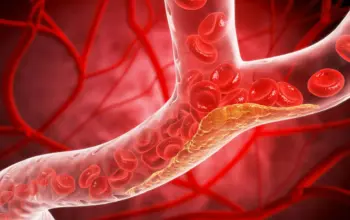 Studi Internasional : 1 dari 3 Dewasa Muda Alami Penyumbatan Arteri