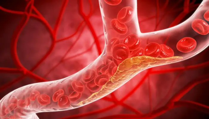 Studi Internasional : 1 dari 3 Dewasa Muda Alami Penyumbatan Arteri